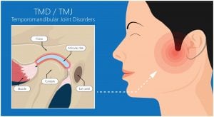 tmj treatment san francisco