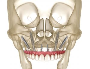 3D anatomical model of human skull showing mandible with 4 dental implants placed in edentulous arch