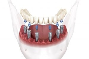 implantes dentales de boca completa san francisco ca
