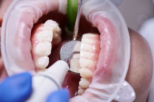 Gloved hand uses rotary instrument with diamond bur to adjust a dental crown on a stone model within a dental articulator; pink gingiva mimic visible