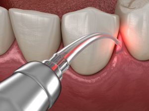laser lanap therapy san Francisco CA