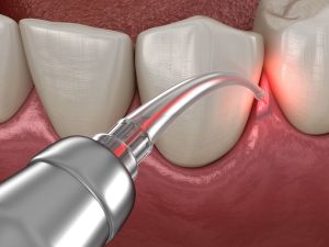 laser lanap therapy san Francisco CA